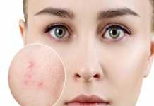 Tổng quan về chẩn đoán điều trị mụn trứng cá dành cho phụ nữ