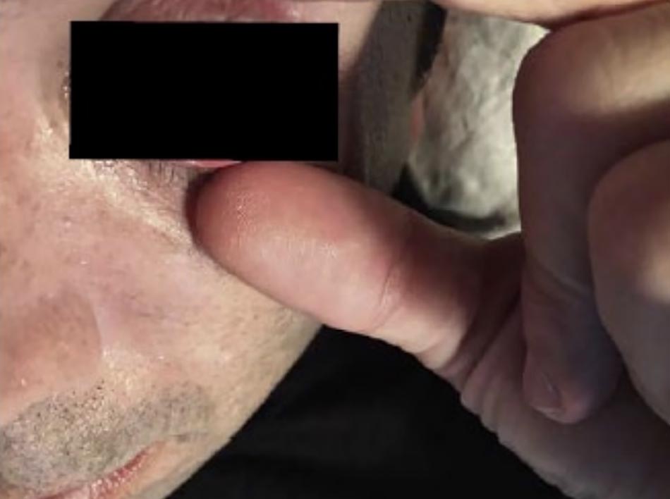 Hình 16.11 Tổn thương mắt sau khi lột da mặt và mắt bằng axit trichloroacetic. Một dai tuyến tính của protein đông tụ (đóng bǎng) được nhìn thấy trên nhãn cầu nơi axit nhỏ giọt vào mắt trong quá trình thực hiện. (Ảnh: Tiến sĩ Joe Niamtu.)