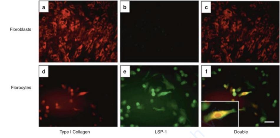 Hình 3.7 Nhuộm miễn dịch tế bào sợi. Nguyên bào sợi biểu hiện nhuộm collagen loại 1 (a), tuy nhiên không tìm thấy protein-1 đặc hiệu bạch cầu (LSP-1) (b). Phương pháp nhuộm miễn dịch kép khẳng định rằng nguyên bào sợi chỉ biểu hiện collagen loại I (c). Mặt khác, các tế bào sợi biểu hiện cả collagen loại I (d), LSP-1 (e), và miễn dịch huỳnh quang kép đã xác định sự hiện diện của cả hai protein (f) [55].