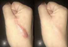 sẹo lồi