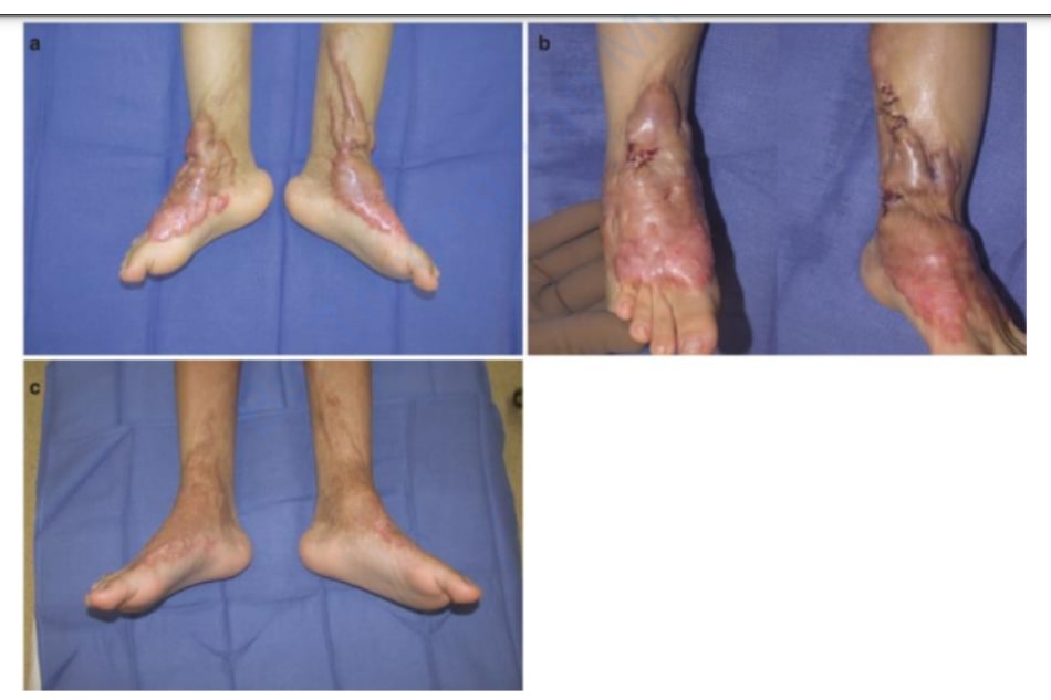Hình 3 (a) Các vết sẹo bỏng phì đại lớn ở cẳng chân, mắt cá chân và bàn chân 1 năm sau chấn thương bỏng. Ban đầu, ban đỏ và ngứa được điều trị bằng PDL. (b) Lực căng trên các khớp mắt cá chân đã được giảm bớt bằng các phẩu thuật z-plasties nhỏ. (c) Năm năm sau, sau 12 lần điều trị bằng laser với CO2 AFL và corticosteroid tại chỗ, sẹo phì đại đã hoàn toàn biến mất. Không có mô sẹo nào được cắt bỏ.