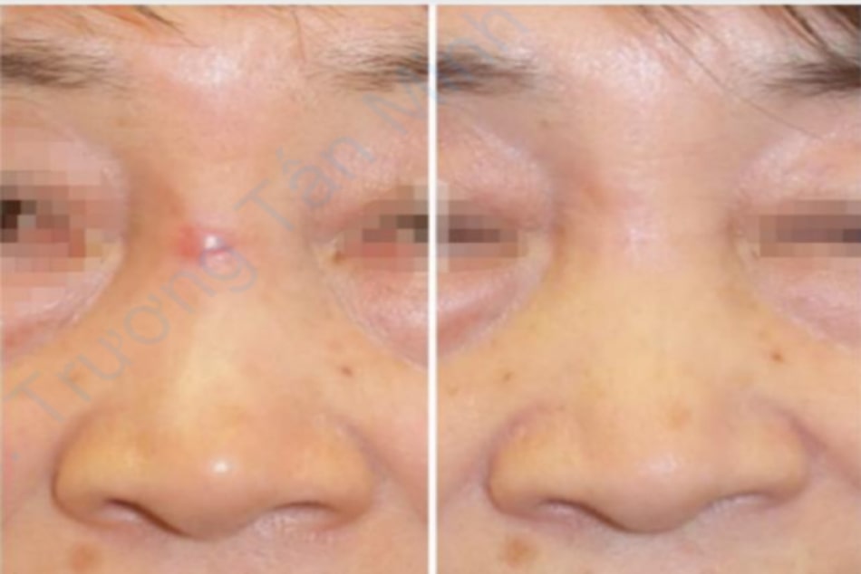 Hình 3 Kết quả của việc dùng kéo dài 2 tháng trên sẹo phì đại ở mũi của một bệnh nhân nữ 73 tuổi