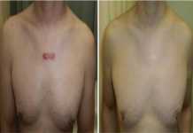 Hình 2 Một người đàn ông 45 tuổi, có sẹo lồi trước ngực được điều trị bằng băng dán trong 36 tháng