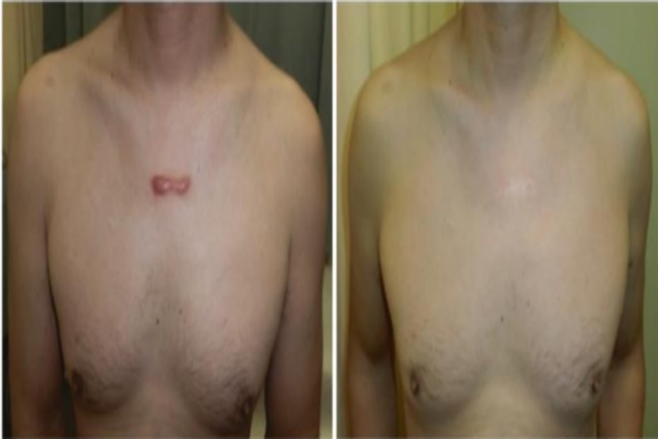 Hình 2 Một người đàn ông 45 tuổi, có sẹo lồi trước ngực được điều trị bằng băng dán trong 36 tháng