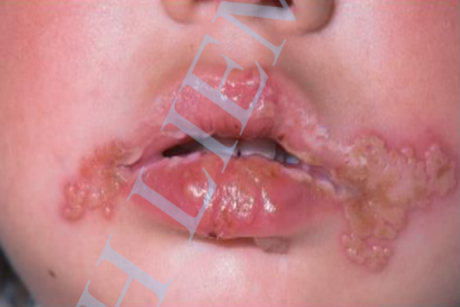 Primary herpes gingivostomatitis. Mụn nước ở môi và quanh miệng của trẻ 10 tháng tuổi