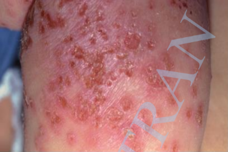 Eczema herpeticum. Mụn nước lõm trung tâm ở trẻ viêm da cơ địa và nhiễm HSV-1
