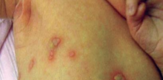 Neonatal herpes. Mụn nước mọc thành chùm ở ngực của trẻ sơ sinh
