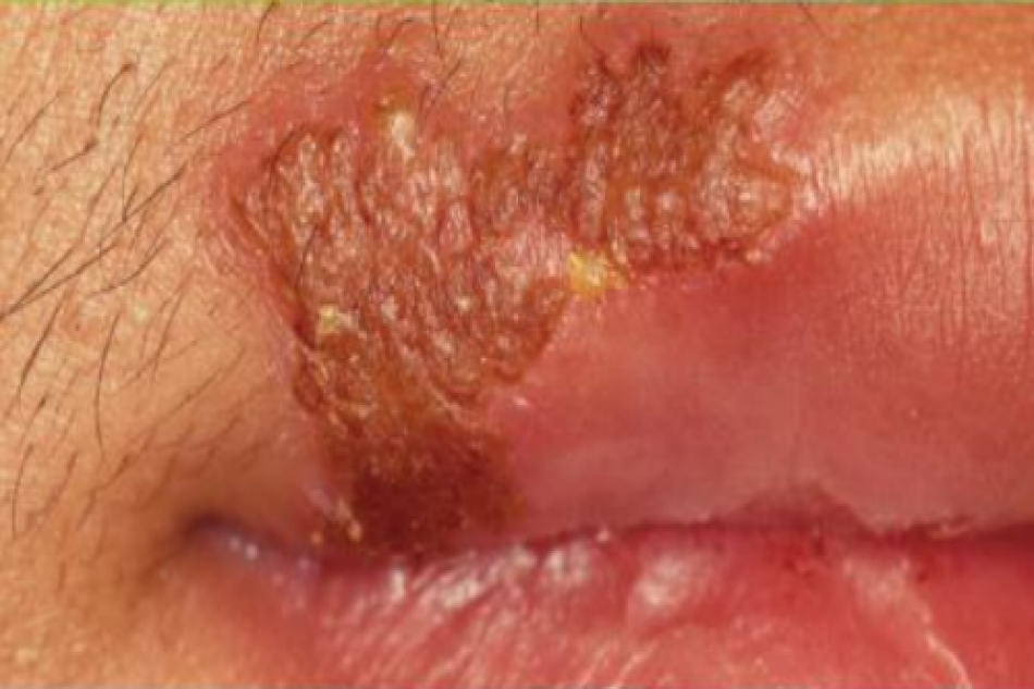 Recurrent herpes labialis với mụn nước mọc thành chùm ở môi trên
