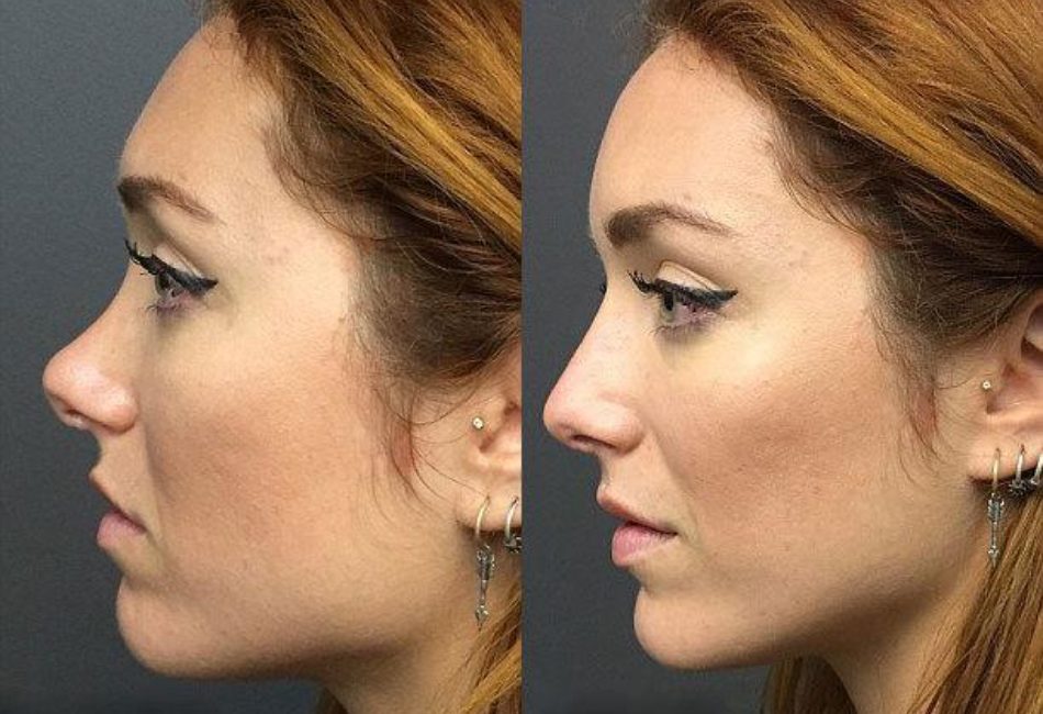 Hình ảnh khách hàng trước và sau khi tiêm filler mũi?