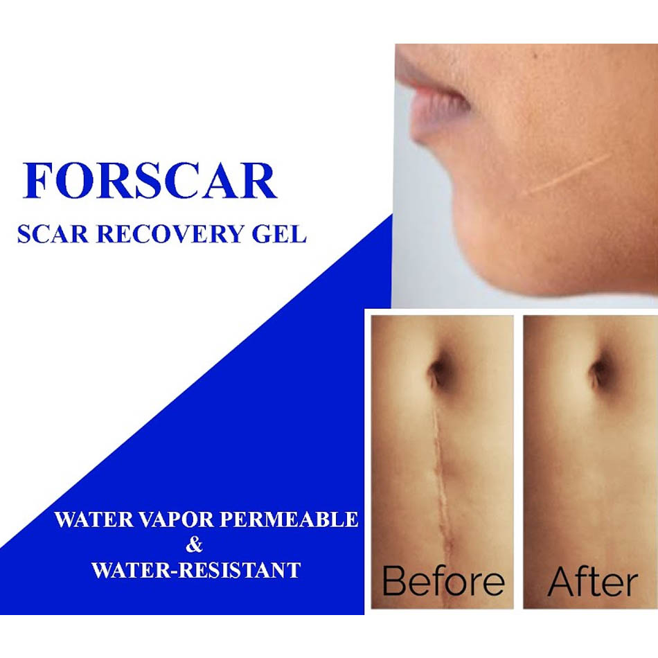 Hiệu quả của Hộp Forscar Scar Recovery Gel