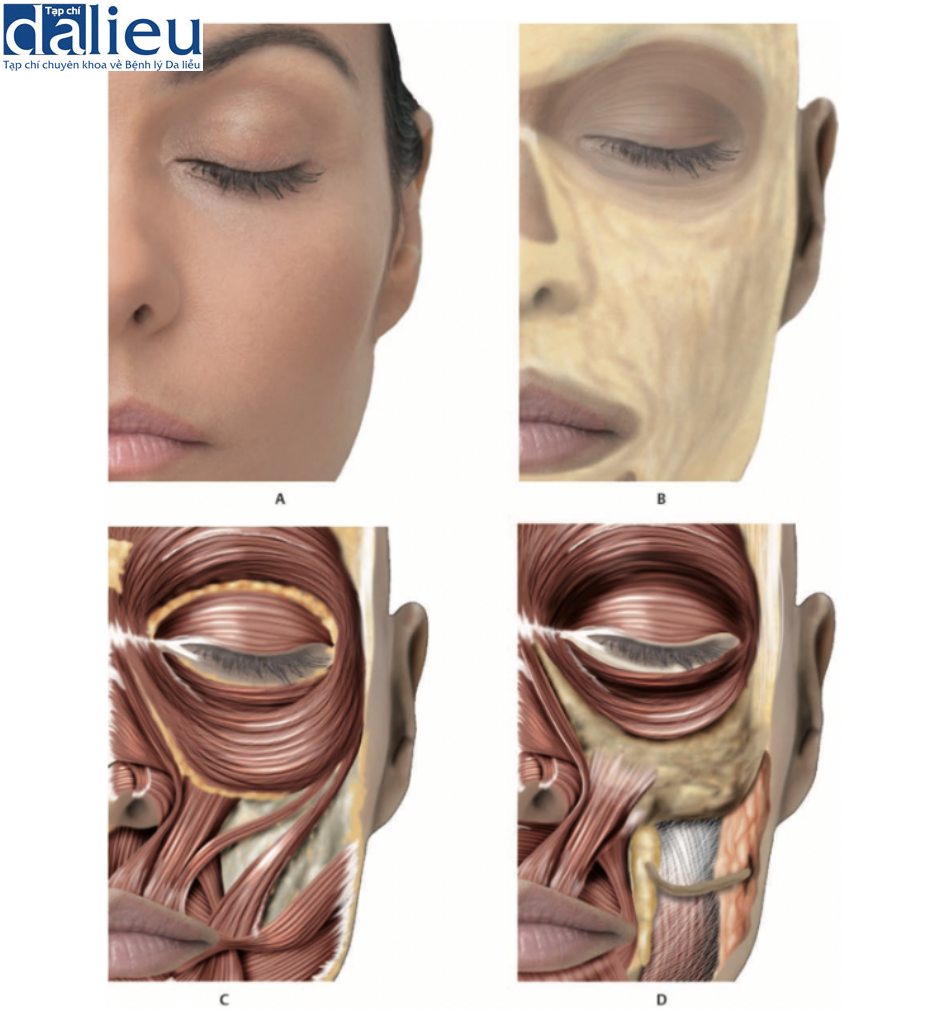 A. Mặt trước vùng nếp gấp mũi môi. B. Sau khi loại bỏ da. C. Sau khi loại bỏ da và các lớp mỡnông (SFP). D. Sau khi loại bỏ da, SFP, phần ổ mắt của cơ vòng mắt (OM), cơ gò má, cơ cười và cơ mút.