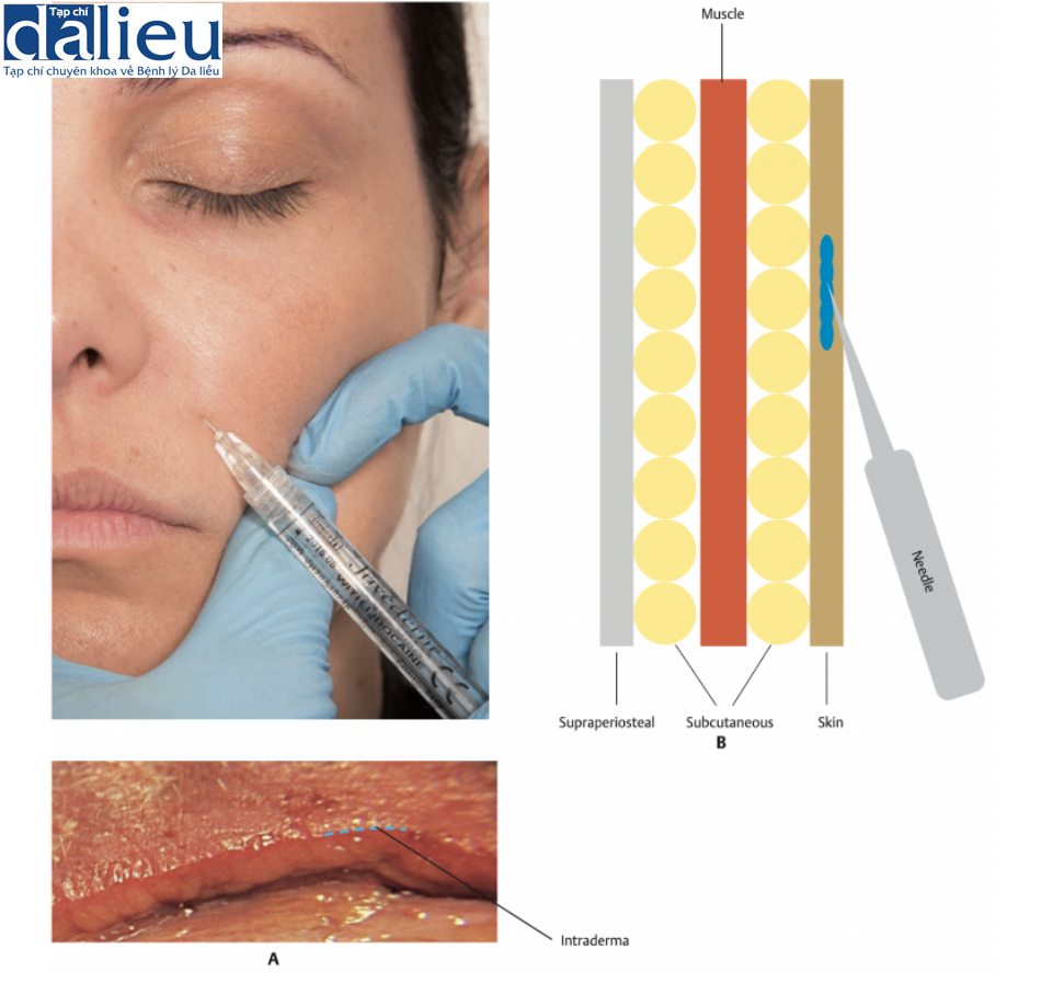 A. Tiêm chất làm đầy vào nếp gấp mũi môi bằng kim ở mặt phẳng trong da. B. Tiêm sản phẩm ởmặt phẳng trong da. Đâm kim ở góc 30°. Có thể thực hiện cả hai phương pháp tiêm thụt lùi hoặc tiến tới.
