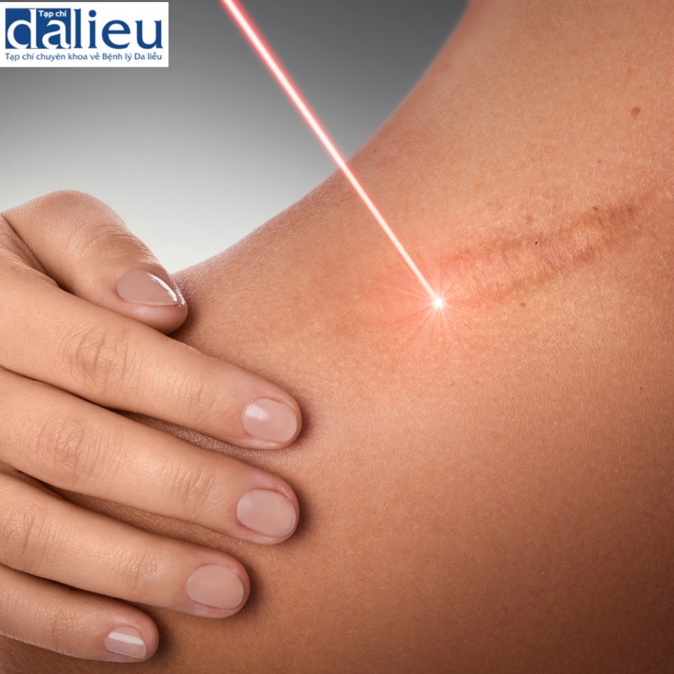 Liệu pháp laser trong điều trị sẹo